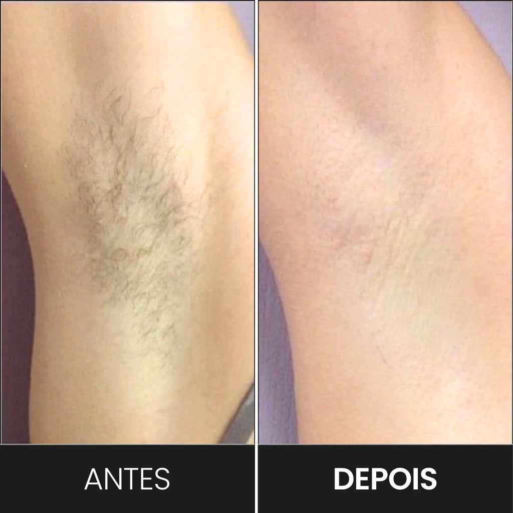 Depilador Profissional À Laser - Silk Pro