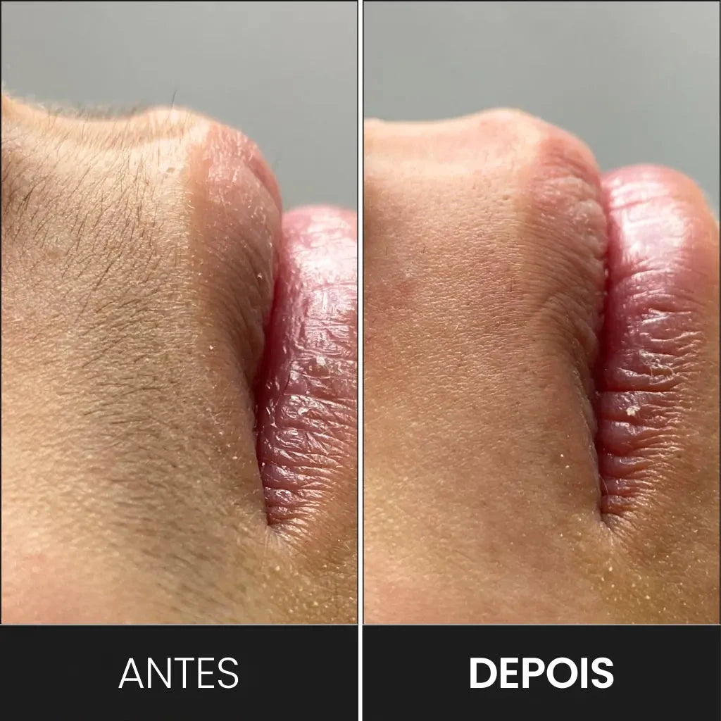 Depilador Profissional À Laser - Silk Pro